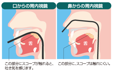 経鼻内視鏡の特徴
